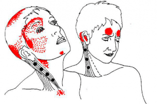 Nguyên nhân gây đau dây thần kinh chẩm Nguyên nhân gây đau dây thần kinh chẩm