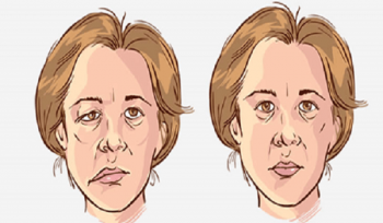 Bị tê mặt là dấu hiệu của những bệnh gì, cách chữa trị