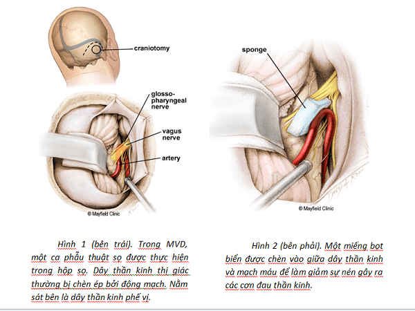 Phẫu thuật điều trị đau dây thần kinh số 9