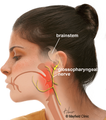 Tình trạng liệt dây thần kinh số 9 thường ít gặp mà thường đi kèm liệt dây 10, 11