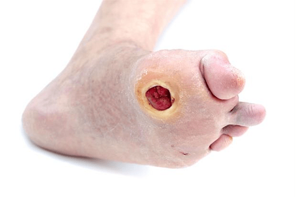 Bàn chân có vết loét là triệu chứng điển hình của bàn chân đái tháo đường
