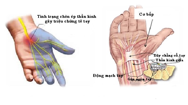 Nguyên nhân gây ra triệu chứng tê bàn tay