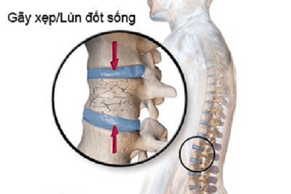 Gãy xẹp - lún đốt sống