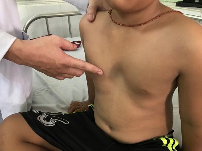 Bệnh lõm ngực có nguy hiểm không?
