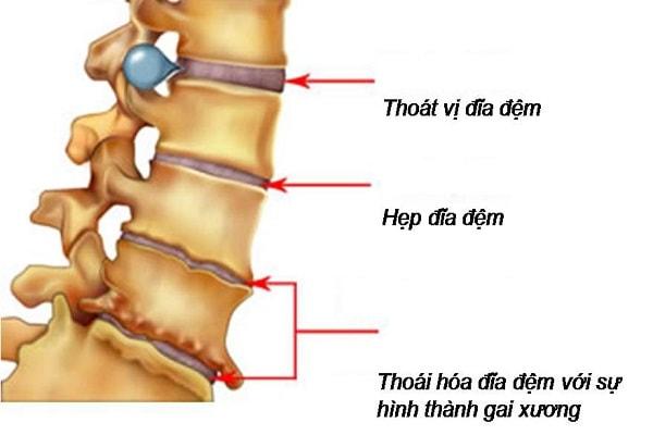 Thoái hóa cột sống