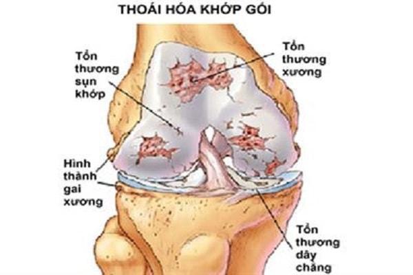 Thoái hóa khớp gối