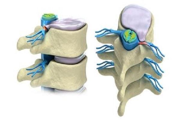 Thoát vị đĩa đệm cột sống