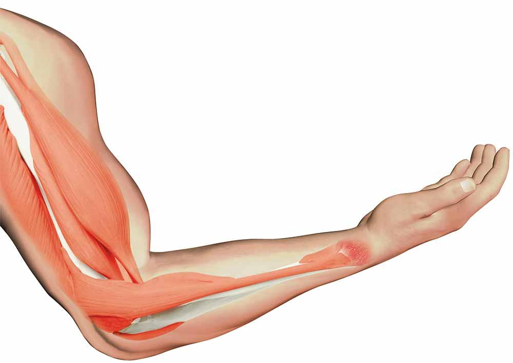 Cơ bắp tay bị co giật - Nguyên nhân và cách phòng ngừa