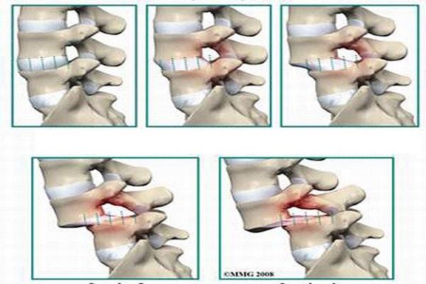 Biện pháp điều trị bệnh thoát vị đĩa đệm cột sống