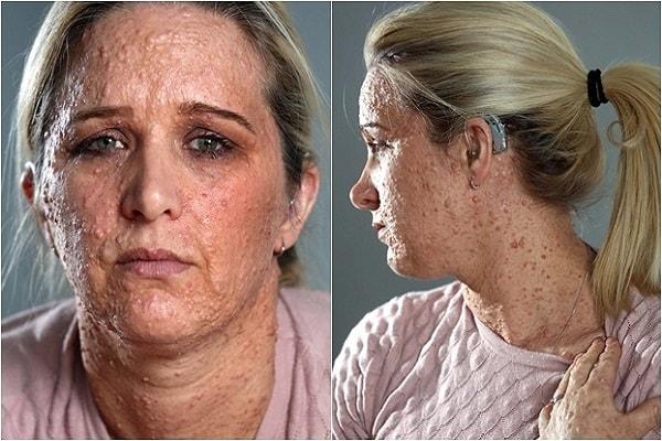 Biện pháp phòng chống bệnh u sợi thần kinh