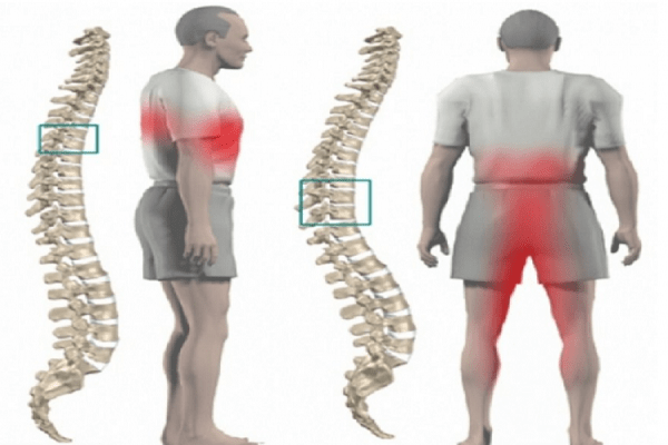 Biện pháp phòng tránh bệnh thoát vị đĩa đệm cột sống