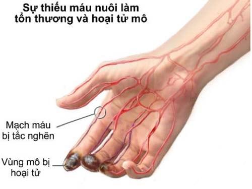 Buerger - viêm thuyên tắc mạch máu