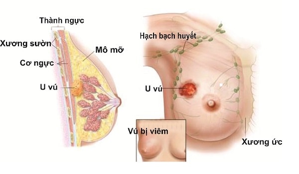 Bệnh bướu sợi tuyến - dấu hiệu, triệu chứng và cách chữa trị