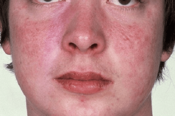 Có những dấu hiệu và triệu chứng nào của bệnh lupus ban đỏ?
