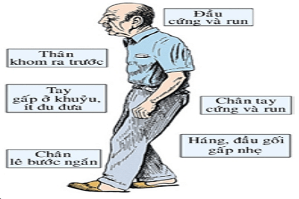 Chẩn Đoán Bệnh Parkinson