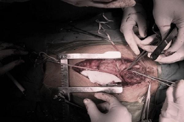 Các hướng điều trị bệnh u sợi thần kinh