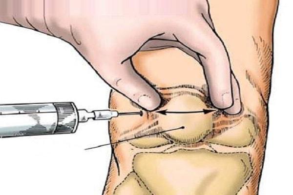 Cách điều trị bệnh tràn dịch khớp gối