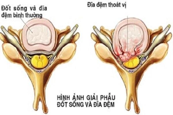 Cách điều trị và phòng chống bệnh thoát vị đĩa đệm cột sống cổ