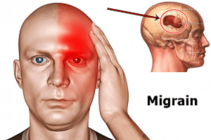 4. Chẩn đoán hội chứng đau nửa đầu Migraine