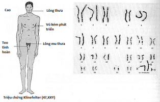 4. Chẩn đoán hội chứng Claiphentơ