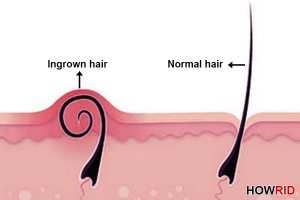 Bệnh lông mọc ngược - dấu hiệu, triệu chứng và cách điều trị
