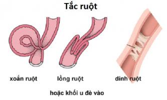 Phương pháp chẩn đoán dính ruột