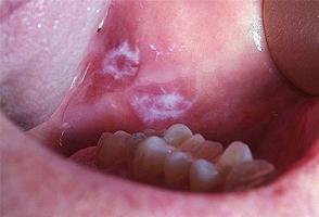 Bệnh ung thư miệng - triệu chứng, nguyên nhân, cách điều trị