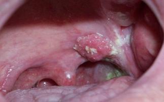 Bệnh ung thư vòm họng - dấu hiêu, triệu chứng và cách điều tr