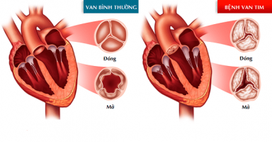 Bệnh van tim