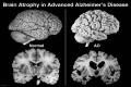 Nguyên nhân của hội chứng mất trí nhớ thường xuyên alzheimer