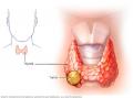 U tuyến giáp lành tính có nên mổ không? U tuyến giáp lành tính có nên mổ không?