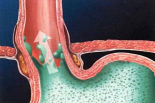 Các biện pháp phòng chống bệnh trào ngược thực quản hiệu quả