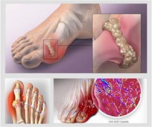 Những điều về bệnh Gout mà bạn cần phải biết
