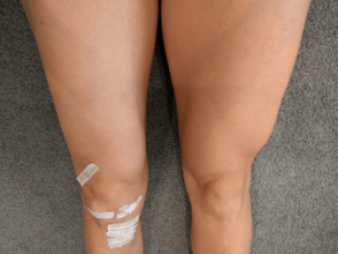Teo cơ chân và cách điều trị Teo cơ chân và cách điều trị