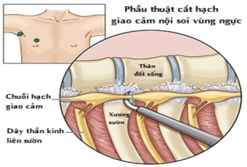 Các phương pháp thay thế phẫu thuật