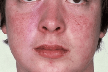 Các Biểu Hiện Của Bệnh Lupus Ban Đỏ