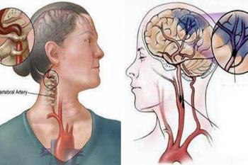 Cách Điều Trị Tai Biến Mạch Máu Não