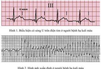 3. Triệu Chứng Của Hạ Kali Máu