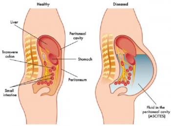 3. Triệu chứng và dấu hiệu nhiễm trùng dịch báng