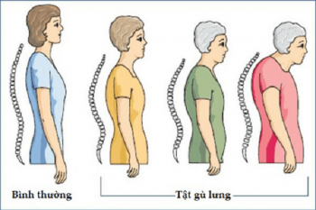 4. Phương pháp điều trị gãy lưng