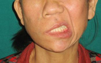 Triệu chứng méo miệng, nguyên nhân và cách chữa trị