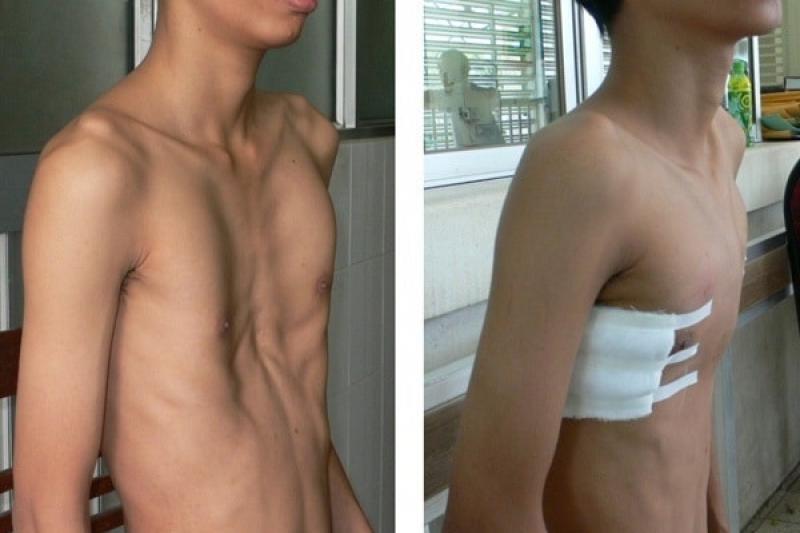 4 phương pháp điều trị bệnh lõm ngực thường được bác sĩ chỉ định
