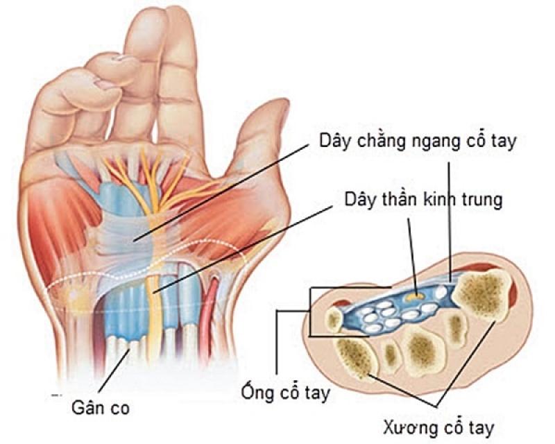 4 sự thật cần biết về hội chứng ống cổ tay để điều trị dễ hơn 4 sự thật cần biết về hội chứng ống cổ tay để điều trị dễ hơn