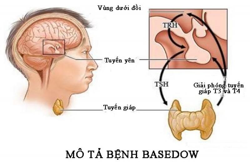 Basedow
