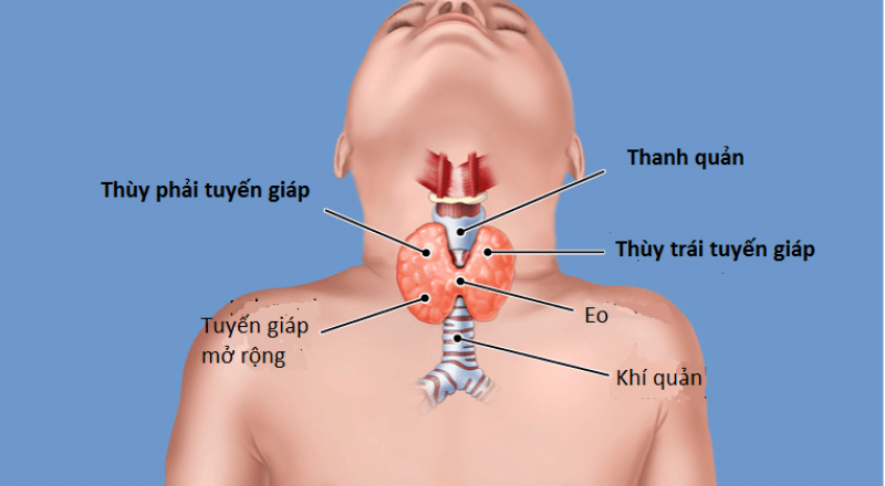 Bệnh cường giáp ở trẻ em là gì? Triệu chứng và cách chữa trị