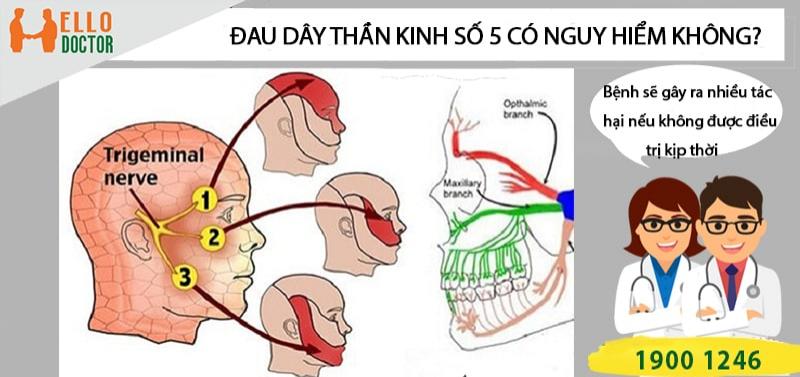 Bệnh đau dây thần kinh số 5 có nguy hiểm không?