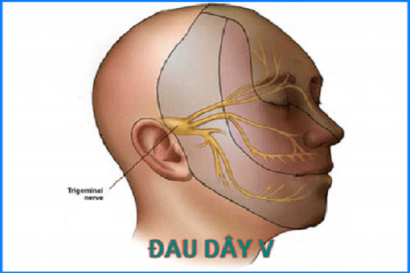 Đau dây thần kinh số V