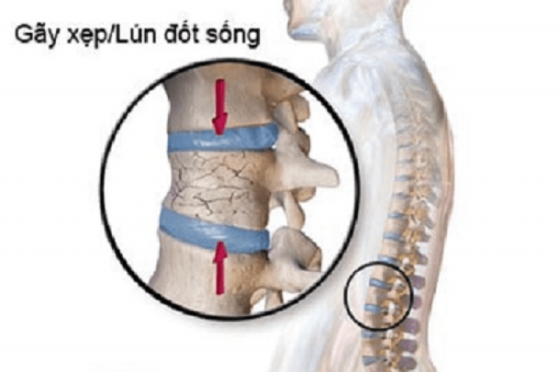Gãy xẹp - lún đốt sống Gãy xẹp - lún đốt sống