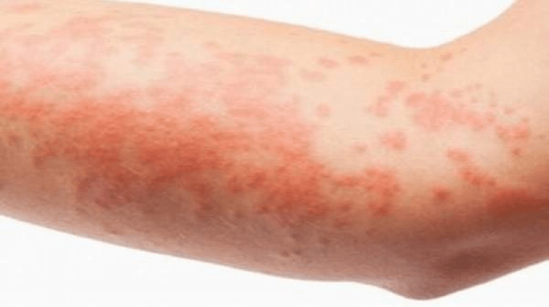 Bệnh HIV bao lâu thì phát bệnh, khi nào bệnh nhân có triệu chứng?