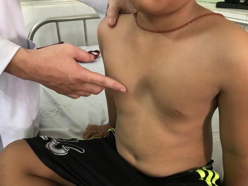 Bệnh lõm ngực có nguy hiểm không?